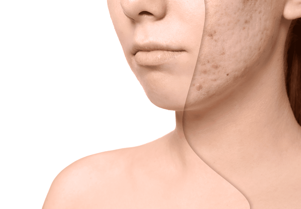 Acne Scar Treatment Leeds