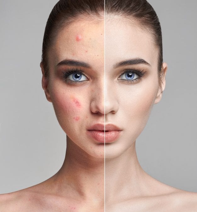 Acne Myths